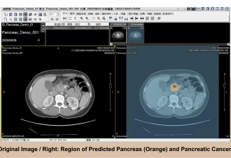 Realizing Comprehensive Personalized Smart Medical Care for Cancer Treatment Through Artificial Intelligence