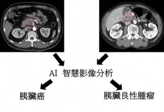 人工智能輔助影像處理提升胰臟腫瘤之偵測與鑑定